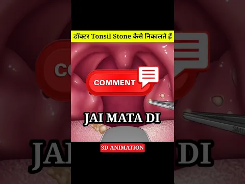 Tonsil Stone कैसे निकाला जाता हैं 😱 #trending #hindi #shorts