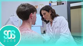 Leonardo è ricoperto di acne in tutto il corpo | Sos Acne