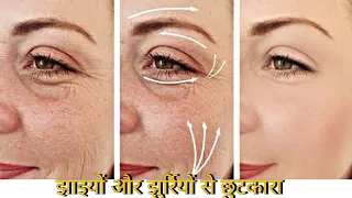 5 साल पुरानी झाइयां//झुर्रियां गायब, चमकदार बना देगा ये अद्भुत नुस्खा, pigmentation remove