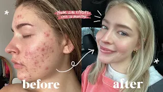MY FULL ACCUTANE JOURNEY | side effects, cost, will it come back?