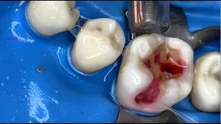 Doctor Peter treated a badly damaged tooth