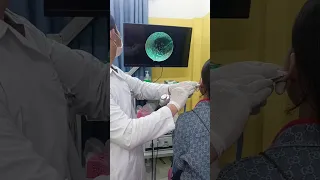 Shocking Inside Ear Footage – Endoscopic Exam! 😱👂 #ENT #CleanEar #MedicalVideo 