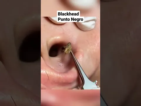 Gran Punto Negro en Oreja #shorts #pimple