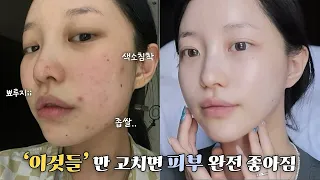 여드름쟁이들 주목🚨 이 '습관들' 제발 고치세요..🤯 돈 안들이고 피부 좋아지는 법!✨
