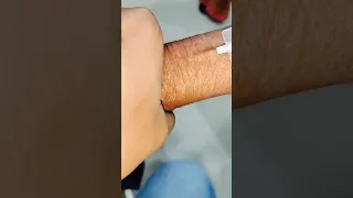 Cannulation.. long video.. part 26 #cannula #vigo
