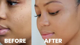 How I Got Rid of My Textured Skin + Improved My Skin