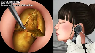 ASMR 시원함 주의! 오랫동안 꽉 막힌 왕귀지 제거하기 | 귀청소 | Deep & Stony Hard Earwax Removal | Ear Cleaning
