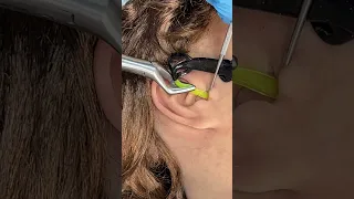 Strange insect removed from ear