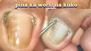 Most satisfying Ingrown toenail removal on the enternet