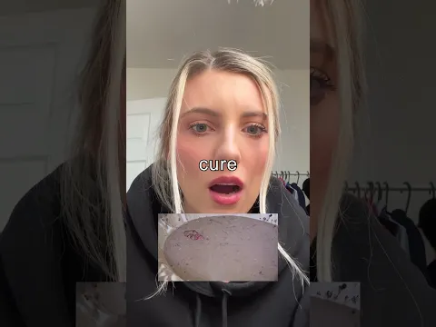 I cured my allergy in 20 minutes