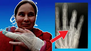 I Broke My Finger. Yes, I'm Serious. (StoryTime)