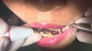 Double clean, scaling teeth #dental #dentist 