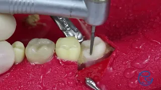 PASO a PASO: EXTRACCIÓN MUELA DEL JUICIO 🦷