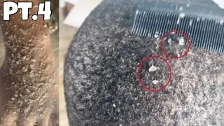 DANDRUFF SCRATCHING | Dry Itchy Scalp | Huge Flakes 🔇 Part 4