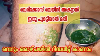 വെരിക്കോസ് വെയിൻ മാറാൻ ഇതു പുരട്ടിയാൽ മതി Home Remedies for Varicose Veins
