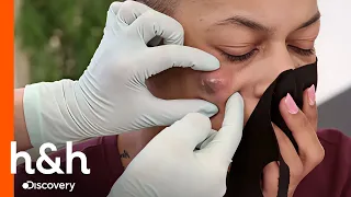 Caroço no rosto cresce sem parar | Dra. Sandra Lee: A Rainha dos Cravos | Discovery H&H Brasil