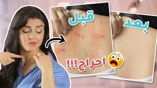 جربت روتين سحري يزيل حب الشباب من الظهر نهائياً !! ( النتيجة فظيعه 😱) | مع جويل
