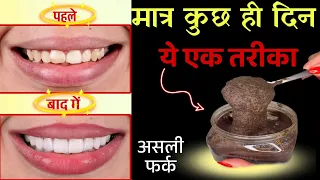 एक तरीका कुछ ही दिन मिलाकर लगा लों,गंदे पीले दांतों को मोतियों जैसा चमका देगा। Teeth whitening tip