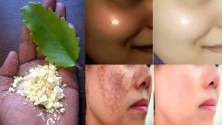 कितना भी कालापन दाग धब्बे छुड़ाकर चेहरा एकदम चांद जैसा खूबसूरत बना देगा | get clear and glowing skin