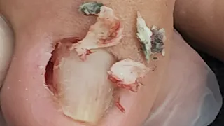Daming nakuha na kuko at ingrown nakabaon