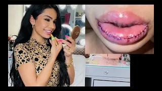 هيك صارو شفايفي بعد عمليتي ل ازالة السليكون - lip silicone removal - ام الياس تعالو تعالو دينا بطايح