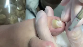 Professional ingrown nail treatment( get rid of ingrown nail with effective method)
