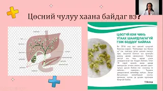 Цөсний чулуу үүсэхээс яаж сэргийлэх вэ?
