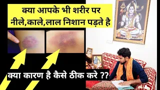 क्या आपके भी शरीर पर नीले,काले,लाल निशान पड़ते है क्या कारण है कैसे ठीक करे ??shiv kripa 8130404375