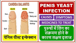 PENIS YEAST INFECTION, TREATMENT, पेनिस यीस्ट इन्फेक्शन, लिंग का संक्रमण होने के कारण लक्षण इलाज