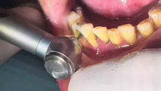Root canal treatment +dental filling #dentist #smiledesigndental #dentalfilling #satisfying 