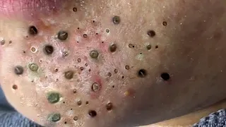 Blackheads Removal at Skin Fix Pro #232
