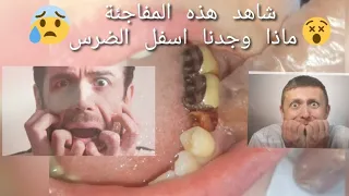 خلع ضرس مكسور | (مفاجأة) كبيرة شاهد ماذا وجدنا اسفل الضرس😳😳😳