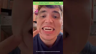 Why Front Teeth Don’t Touch😱