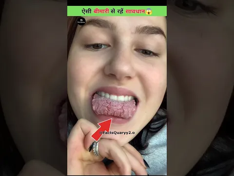 Why The Tongue Cracks