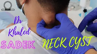 Massive Neck CystDr Khaled Sadek. LipomaCyst.com