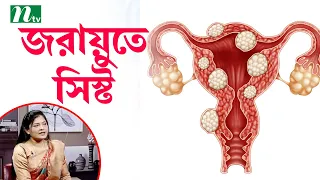 ওভারিয়ান সিস্ট কী? এর লক্ষণ ও উপসর্গ। ডা. জয়শ্রী সাহার পরামর্শ Shastho Protidin স্বাস্থ্য প্রতিদিন