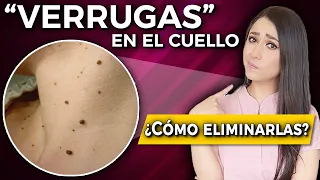 "VERRUGAS” en el cuello l Cómo ELIMINARLAS, qué son y por qué salen👩🏻‍⚕️