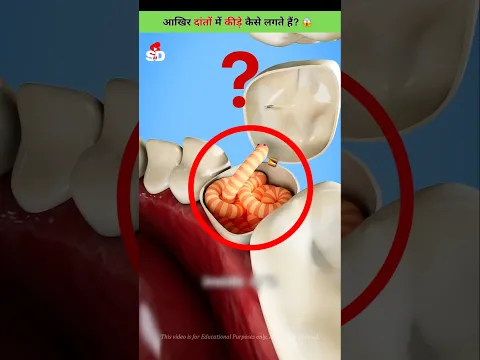 दांतों में कीड़े कैसे लग जाते हैं? 😱