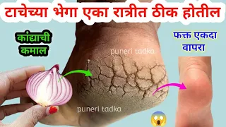 एकदा कांदा वापरा टाचेला पडलेल्या भेगा रात्रीत ठीक होतील 😱crack heels / marathi kitchen tips / recipe