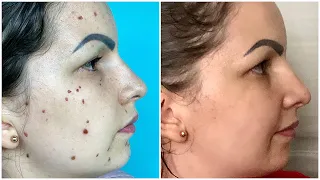 COMO REMOVI AS PINTAS DO MEU ROSTO