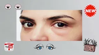 علاج انتفاخ العين 👁بعد البكاء بطرق منزلية سهلة✔️