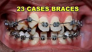 23 Case Braces Transformation
