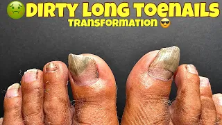 DIRTY LONG TOENAILS TRANSFORMATION