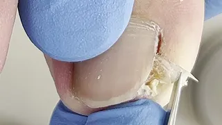 Curly chunks of ingrown nails, clean dead skin thoroughly【Xue Yidao】
