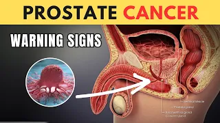 The PROSTATE CANCER Signs I Wish I Knew Sooner!