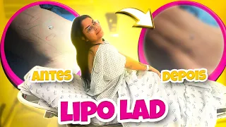 CHEGOU O GRANDE DIA!! FIZ A LIPO LAD + ANTES E DEPOIS 🔥