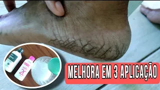 Acabe com as RACHADURA NOS PÉS e Deixe os Pés Macios com apenas 3 Ingredientes !