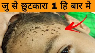 प्याज मे बस ये मिला लो 1 हि बार में जु ऐसे गायब होगी जैसे कभी थी हि नहीं  Lice removal home remedy