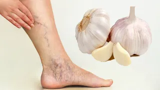 Adieu les Varices avec ces 2 Recettes Naturelles