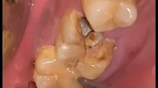 The doctor treated the tooth by replacing it with a new one